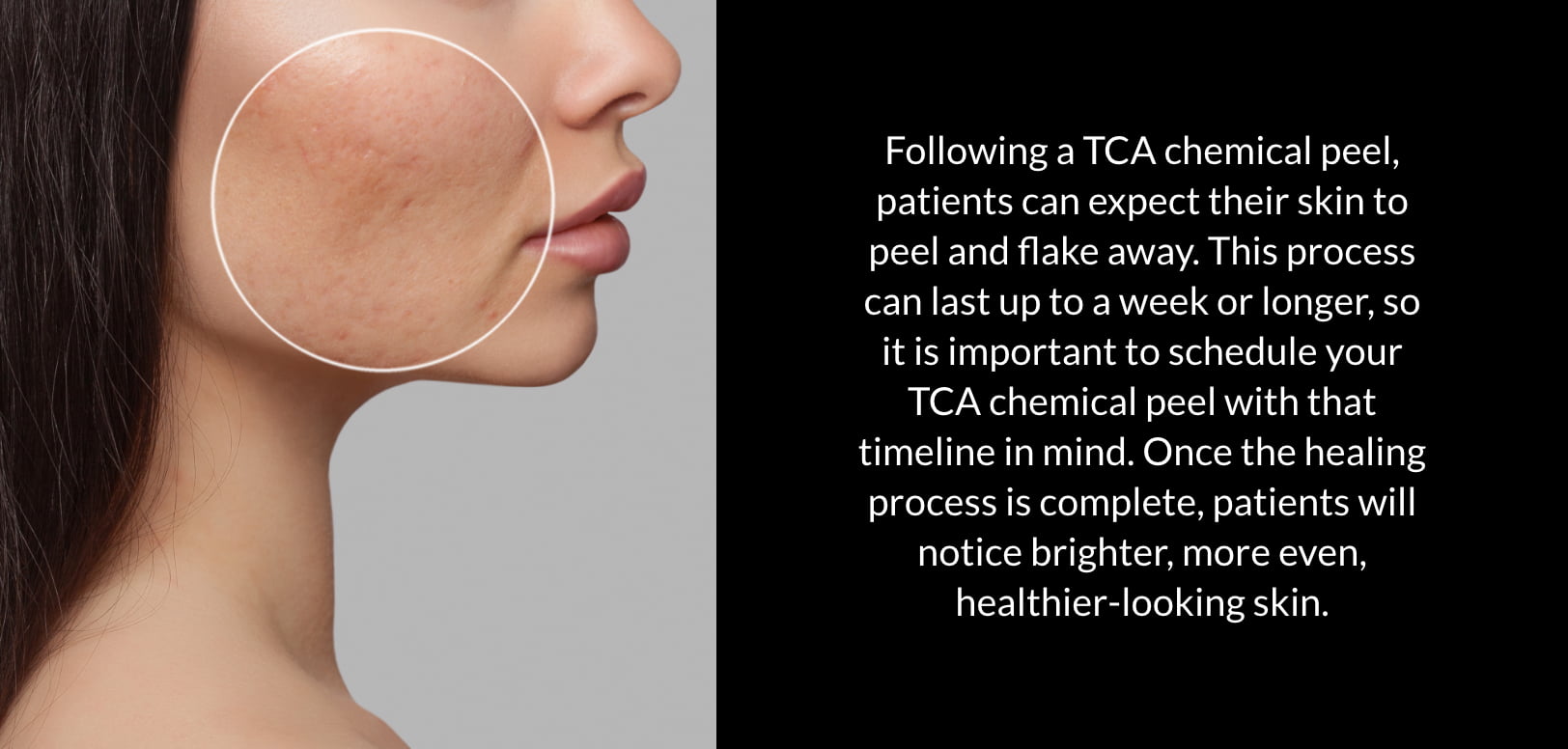TCA Chemical Peel Treatments | Kaysville Utah by Crystal Skin