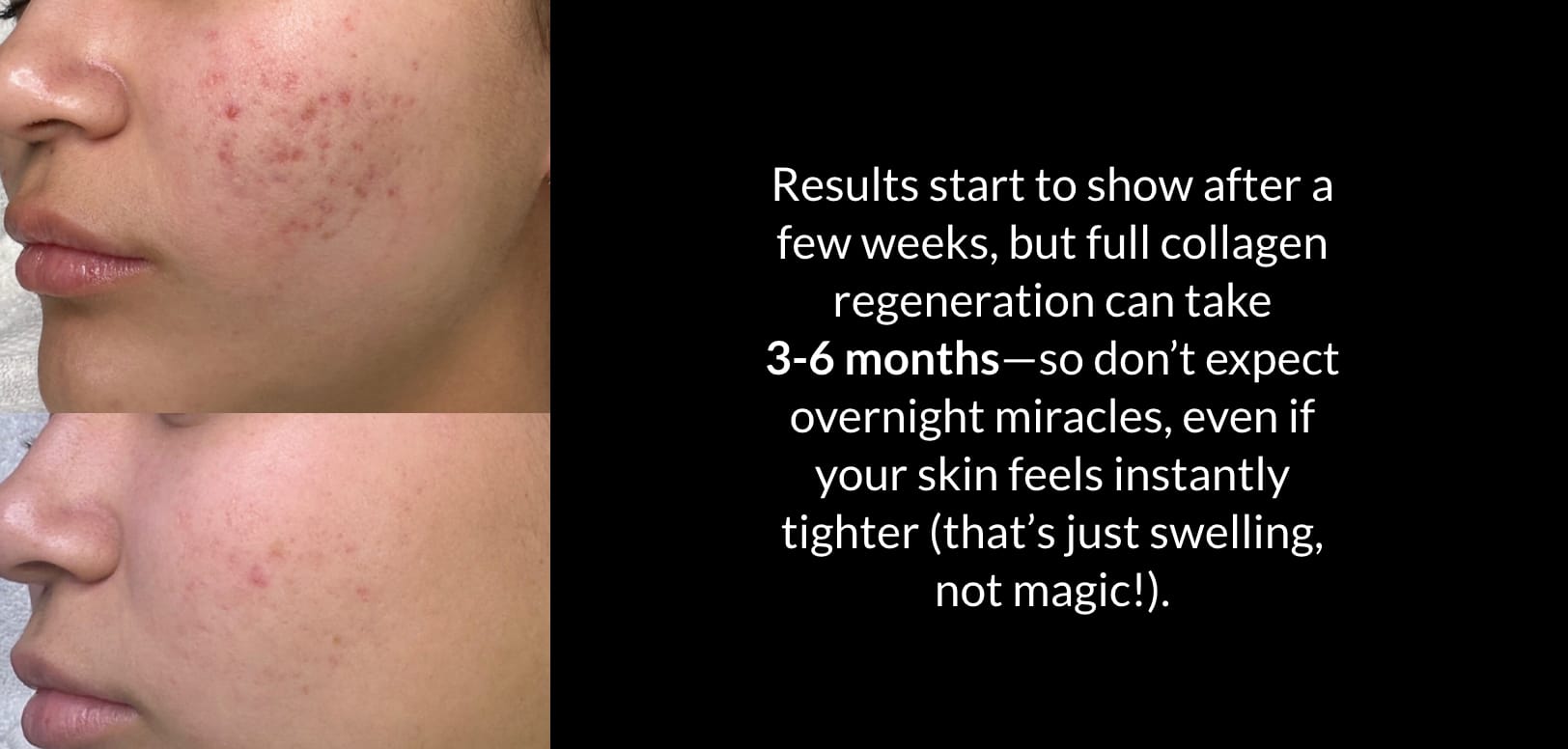 Microneedling Treatments to Boost Collagen | Kaysville Utah by Crystal Skin