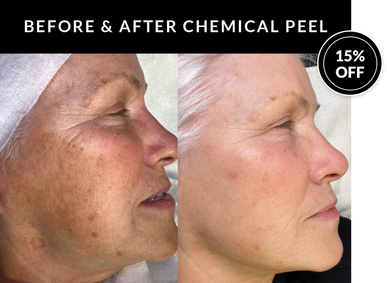 Crystal Skin Products | Kaysville UT | Save 15% on Chemical Peels!