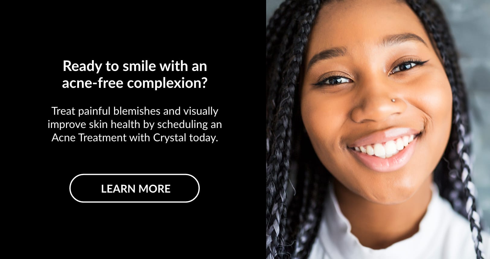 Acne Treatments | Kaysville Utah by Crystal Skin