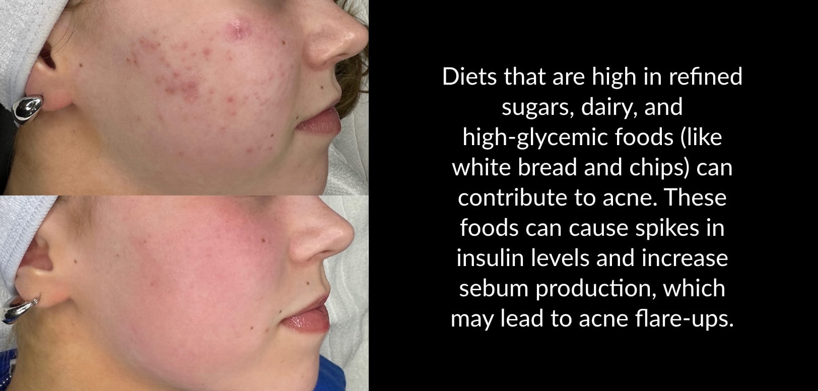 Acne Treatments | Kaysville Utah by Crystal Skin