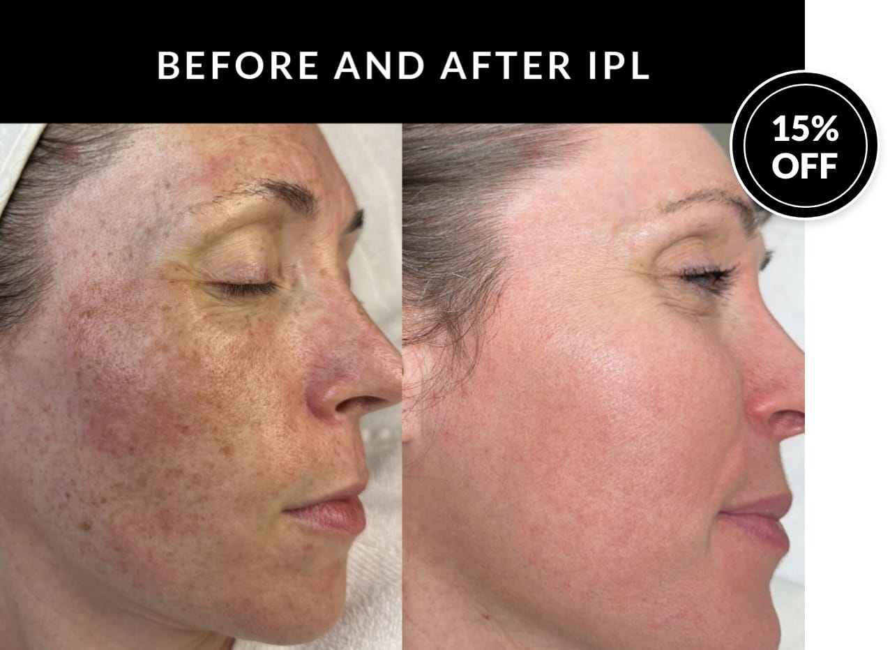 Crystal Skin Products | Kaysville UT | Save additional 10% on IPL packages.