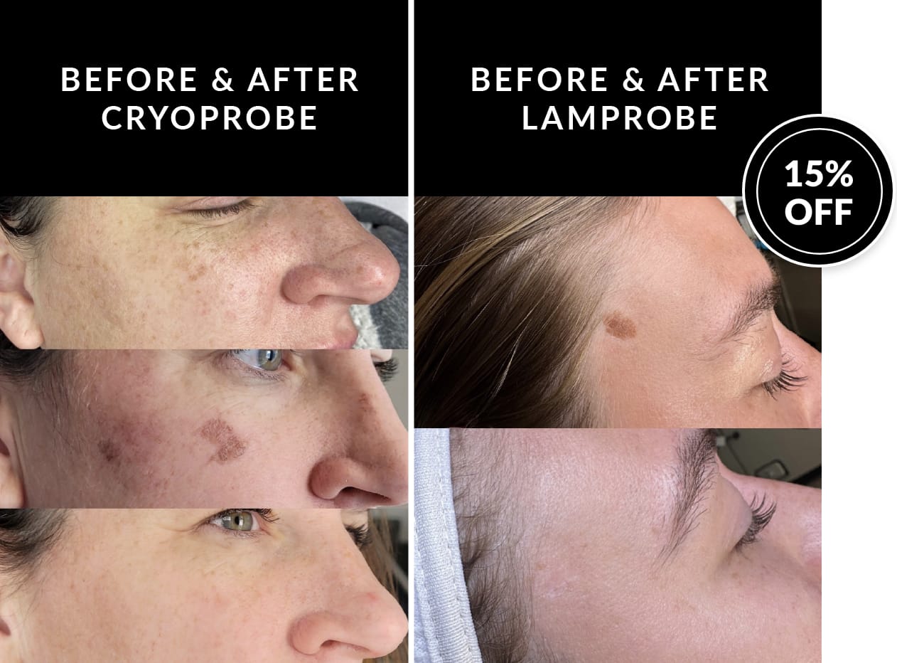 Crystal Skin Care | Kaysville Utah | 15% Off zapping & freezing treatments.