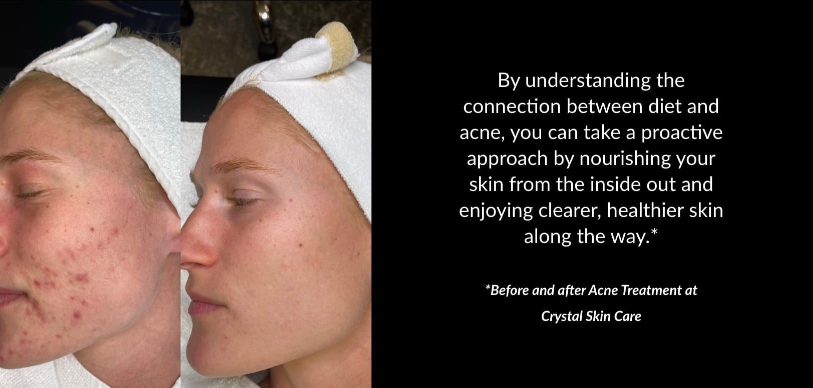 Acne Treatments | Kaysville Utah by Crystal Skin