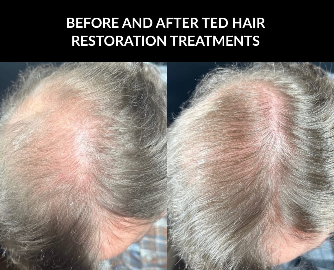 Crystal Skin Care | Kaysville Utah | Before and After TED Treatments