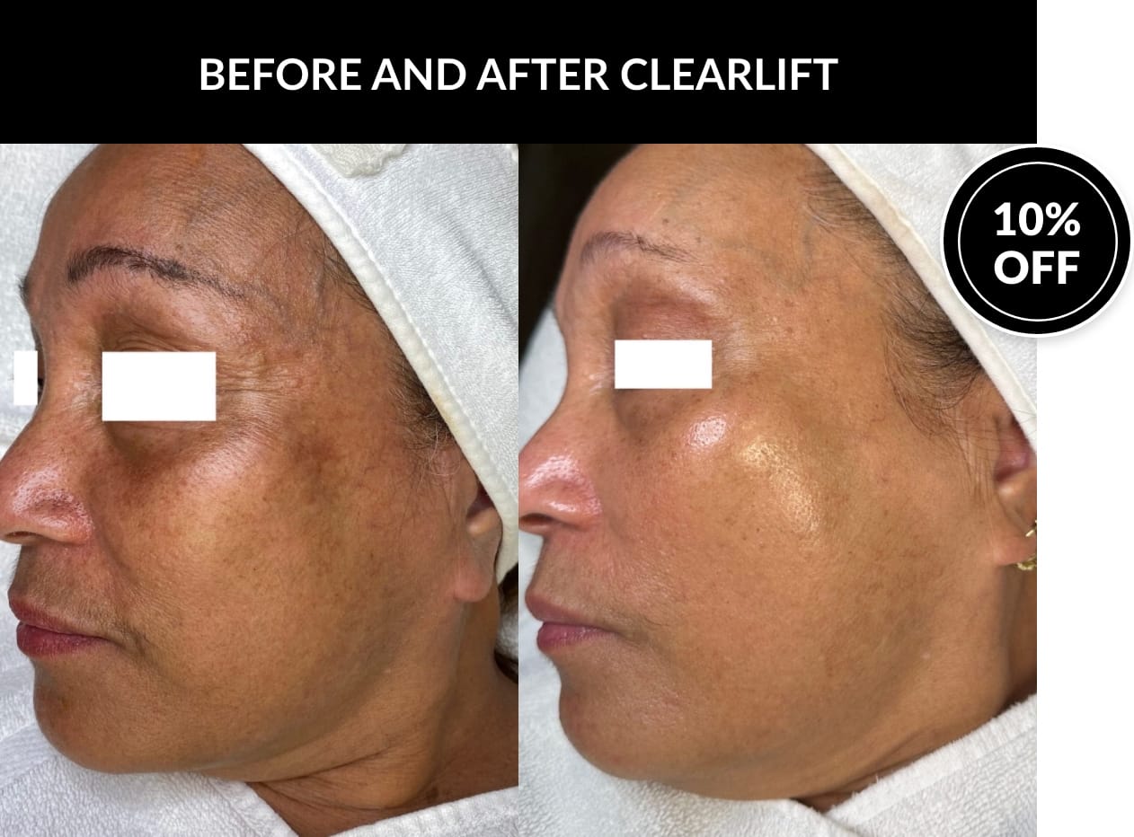 Crystal Skin Care | Kaysville Utah | Before and After Acne Treatments