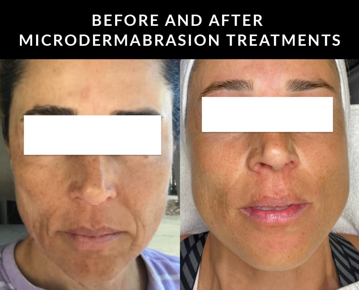 Crystal Skin Care | Kaysville Utah | Before and After Microdermabrasion Treatments