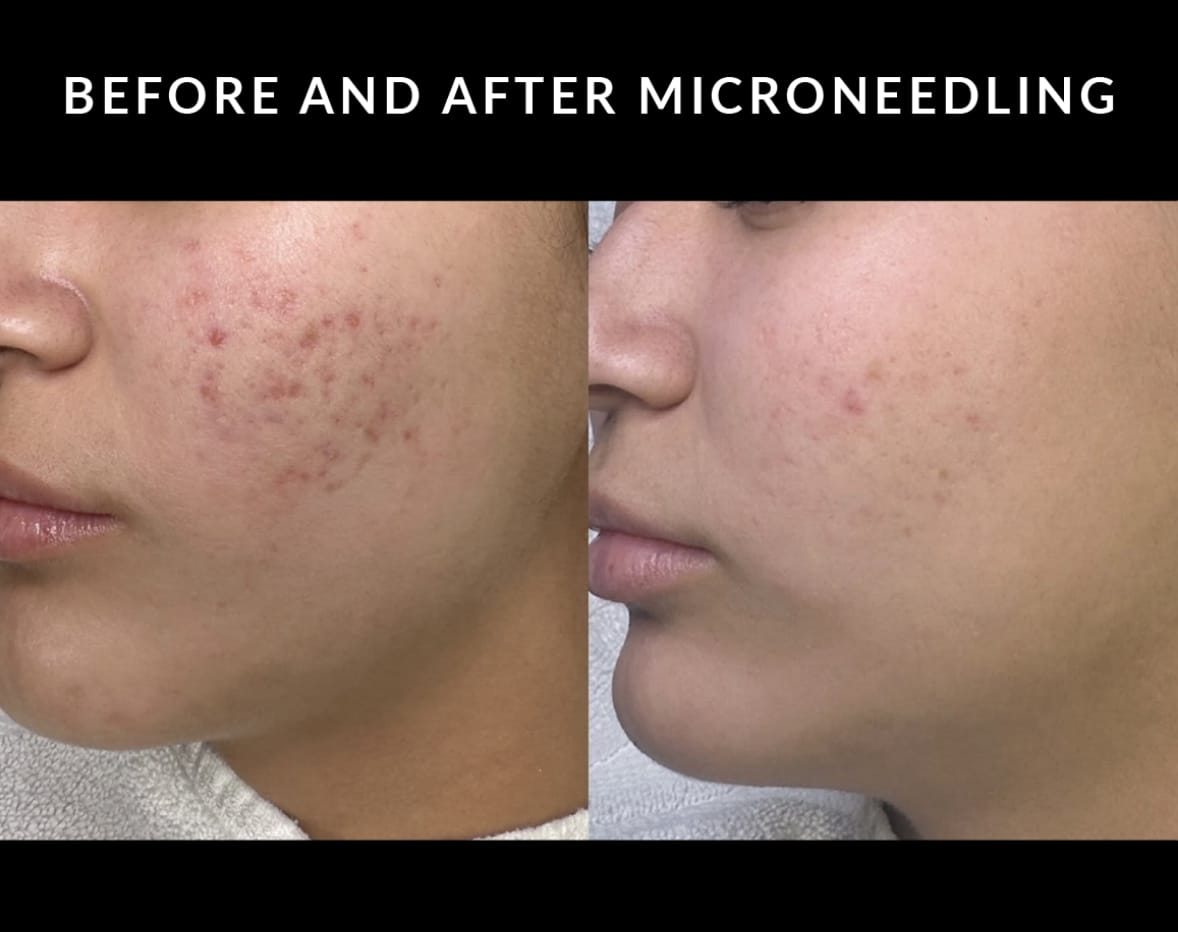 Crystal Skin Care | Kaysville Utah | Before and After Microneedling Treatments
