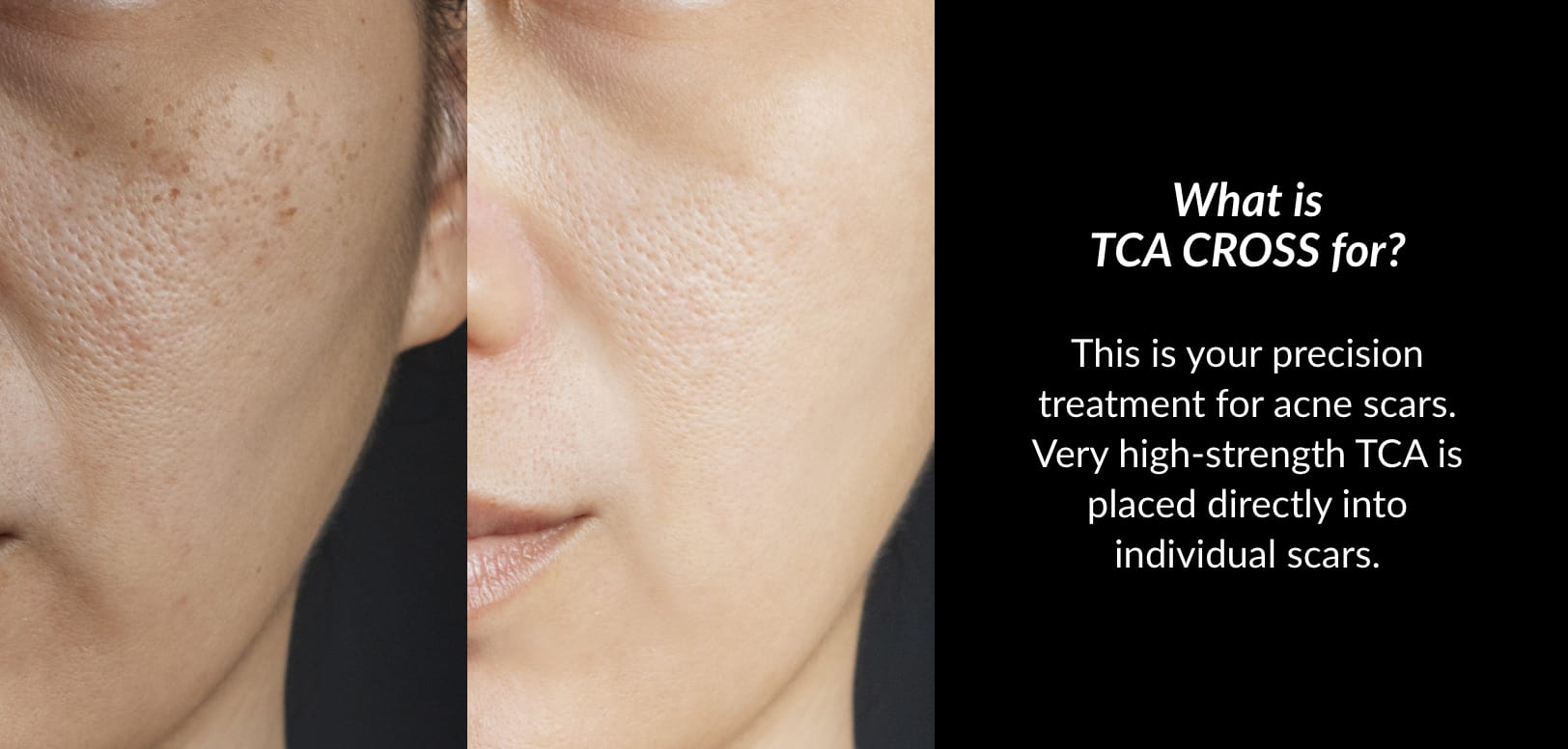 TCA stands for trichloroacetic acid, and it’s part of the chemical peel family.
