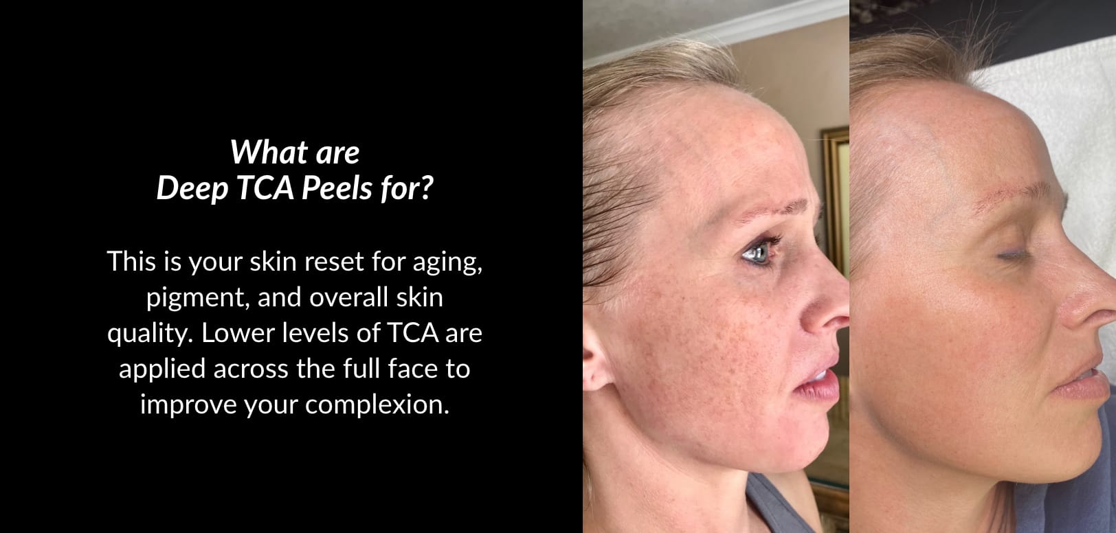 Crystal Skin Care | Kaysville Utah | TCA Skin Treatments