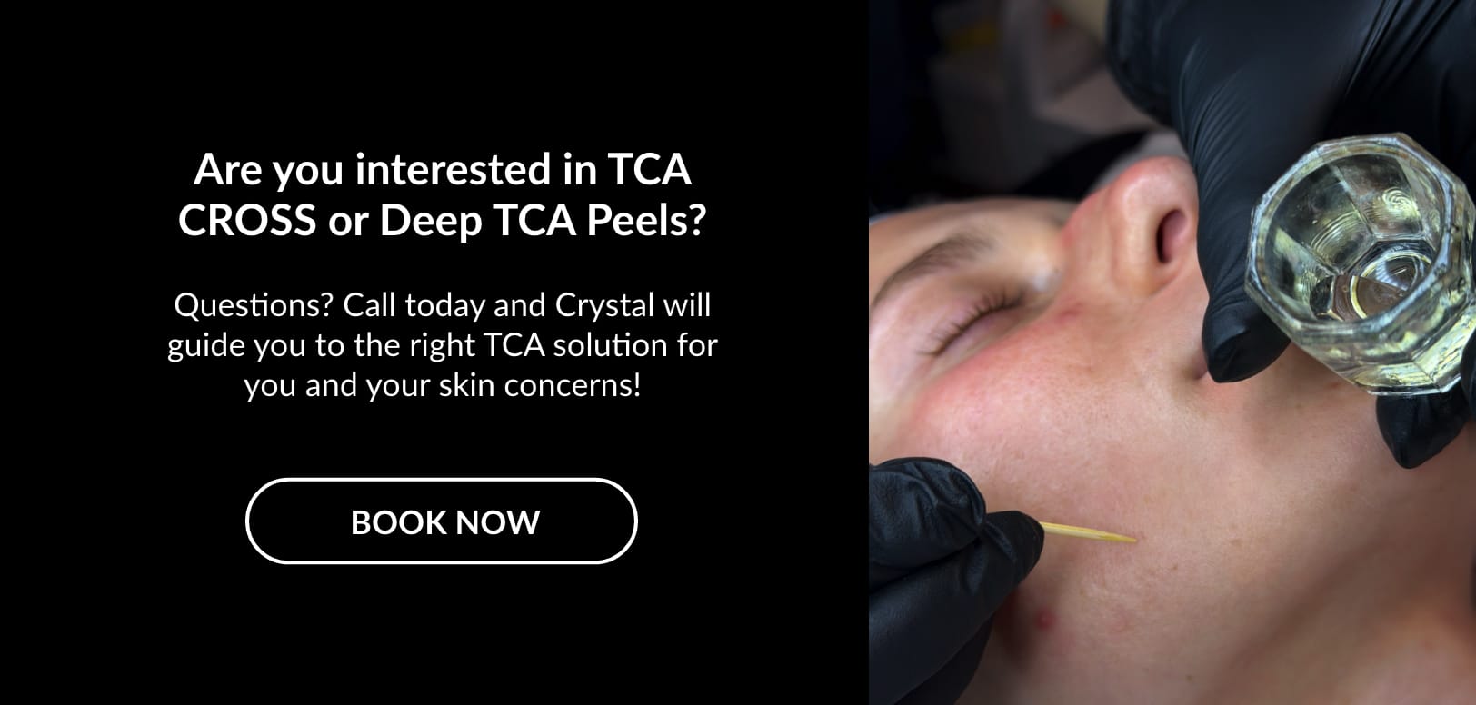 TCA Treatments | Kaysville Utah by Crystal Skin