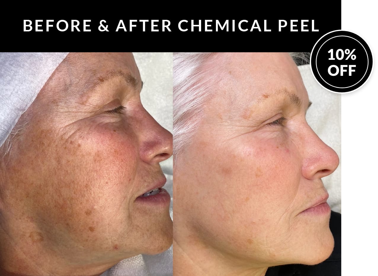 Crystal Skin Care | Kaysville Utah | Save 10% on Chemical Peels.